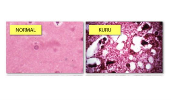 Ткань мозга: норма и патология Куру