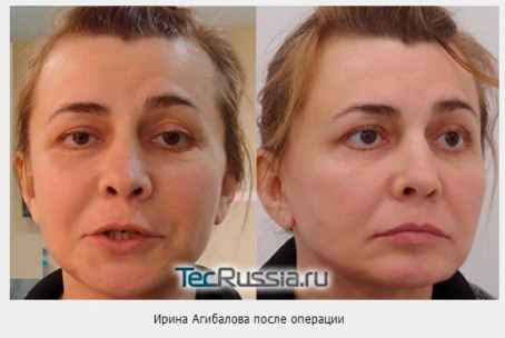 Результаты пластической операции Ирины Александровны Результаты пластической операции Ирины Александровны