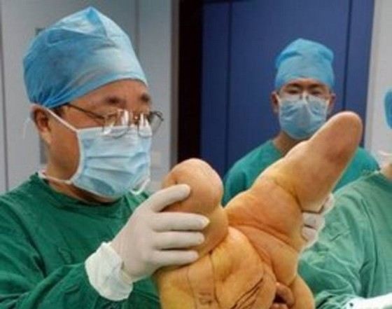 Самую большую руку в мире пришлось удалять хирургически Самую большую руку в мире пришлось удалять хирургически