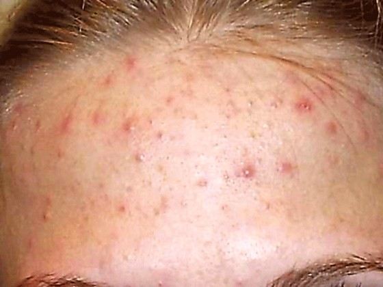 Чаще всего людей беспокоят прыщи на лице Чаще всего людей беспокоят прыщи на лице