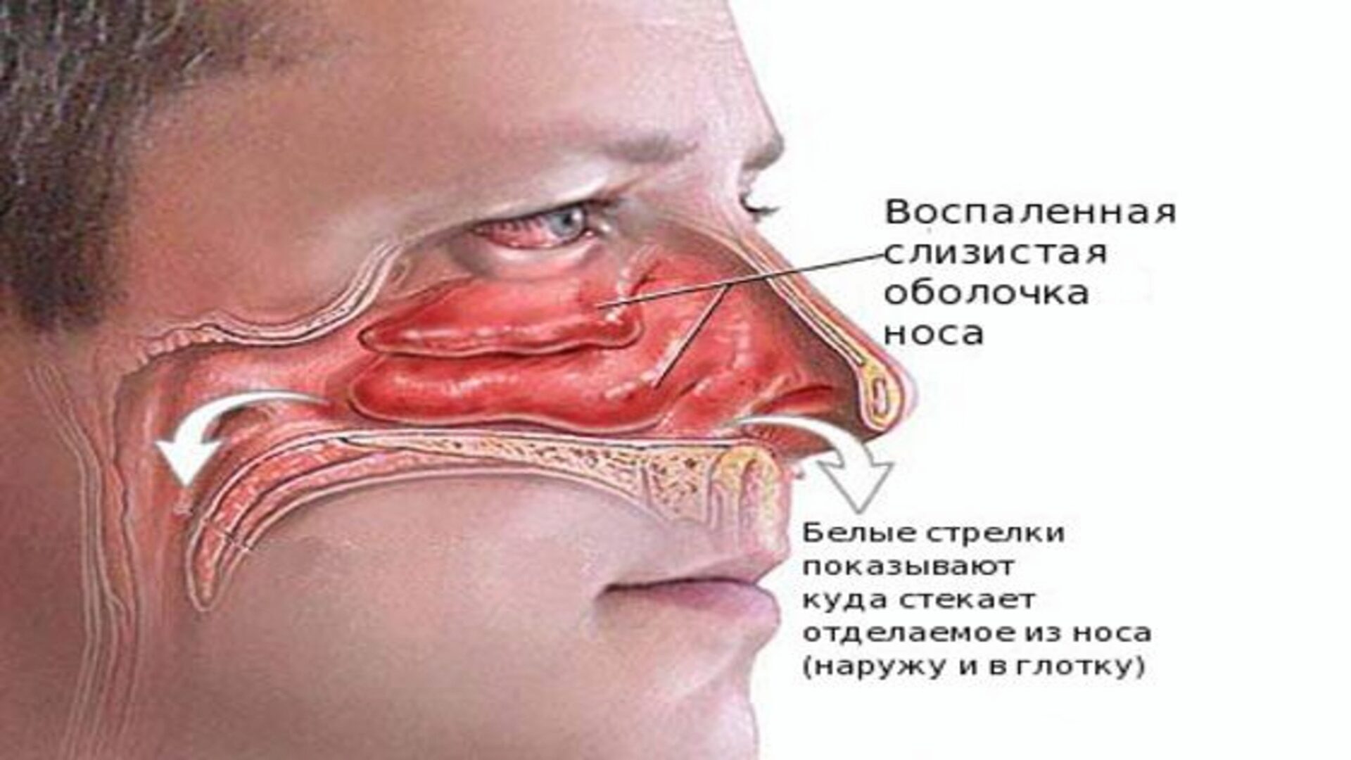 Симптромы насморка Симптромы насморка