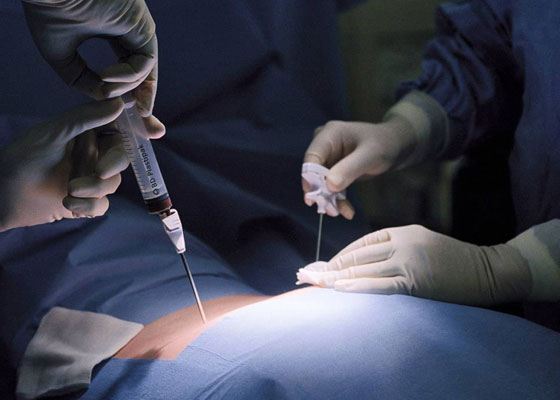 При помощи специального сверла сверлится отверстие в бедренной кости, из которого и проводится забор костного материала При помощи специального сверла сверлится отверстие в бедренной кости, из которого и проводится забор костного материала