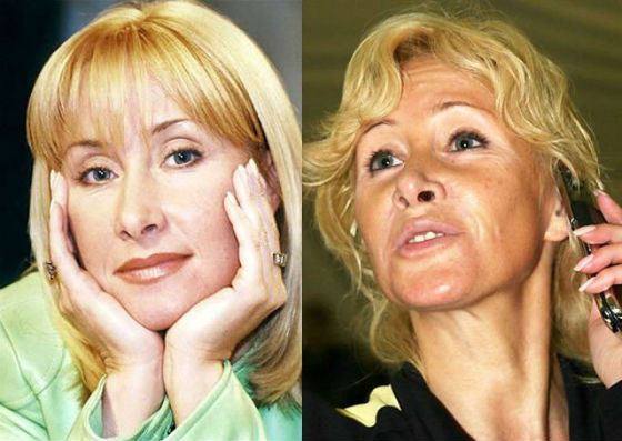 Оксана Пушкина неудачно прошла курс мезотерапии Оксана Пушкина неудачно прошла курс мезотерапии