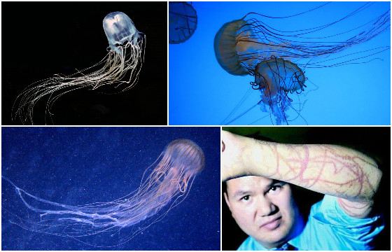 Ожог морских ос очень болезненный